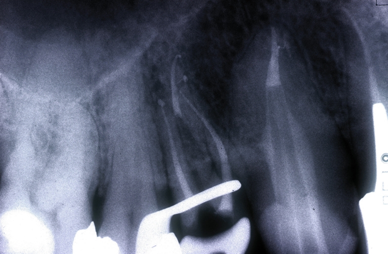 Trattamenti endodontici