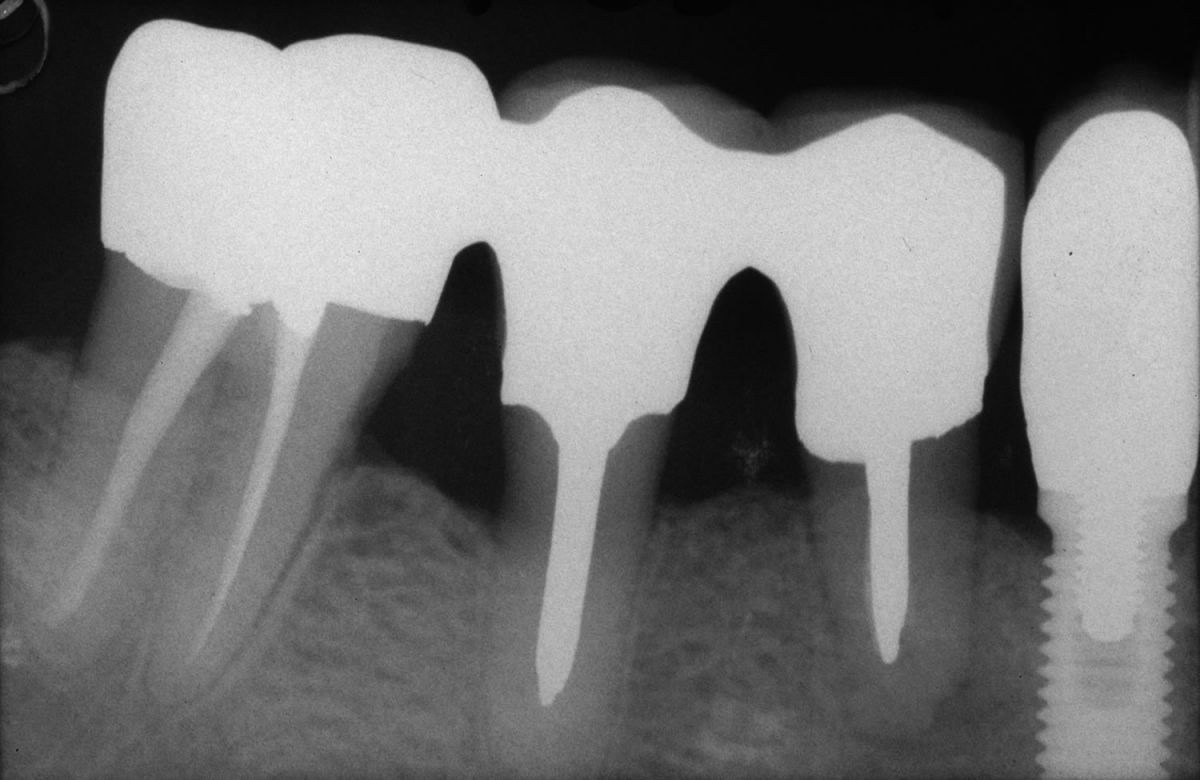 Endodonzia chirurgica
