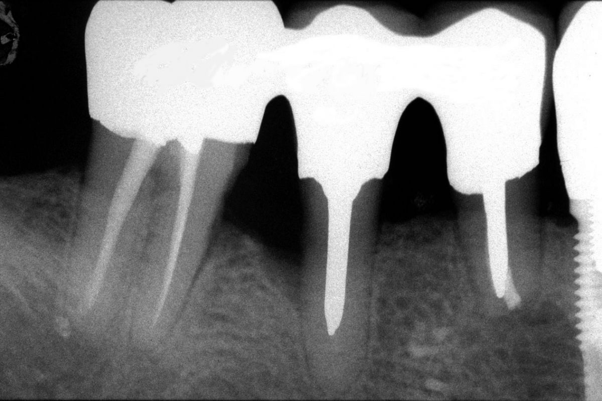 Endodonzia chirurgica