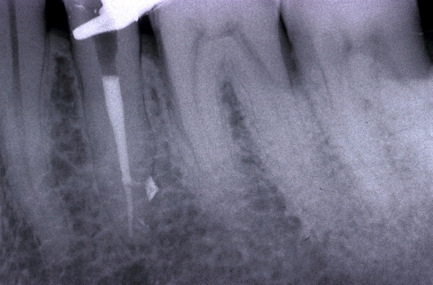 Trattamenti endodontici