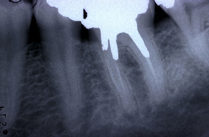 Ritrattamenti endodontici
