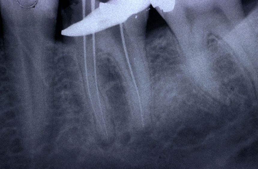 Ritrattamenti endodontici
