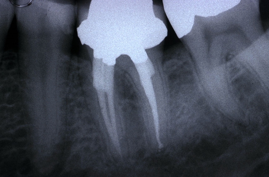 Ritrattamenti endodontici