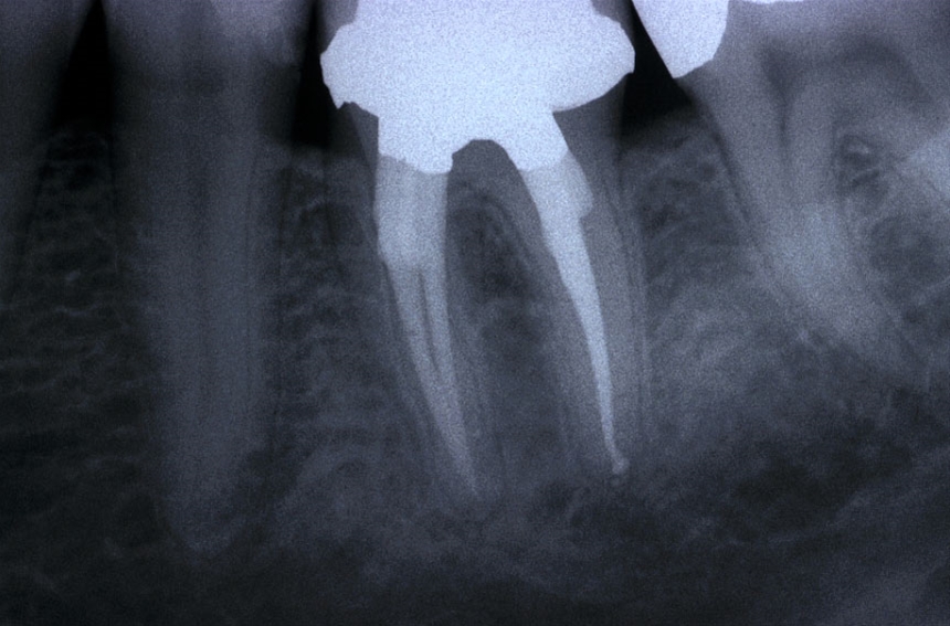 Ritrattamenti endodontici