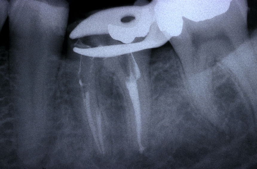 Ritrattamenti endodontici