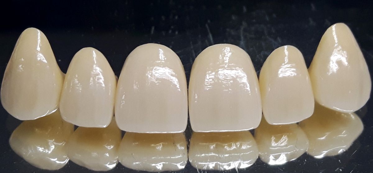 Corone in ceramica integrale