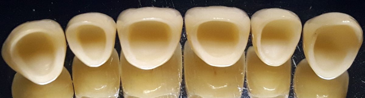 Corone in ceramica integrale