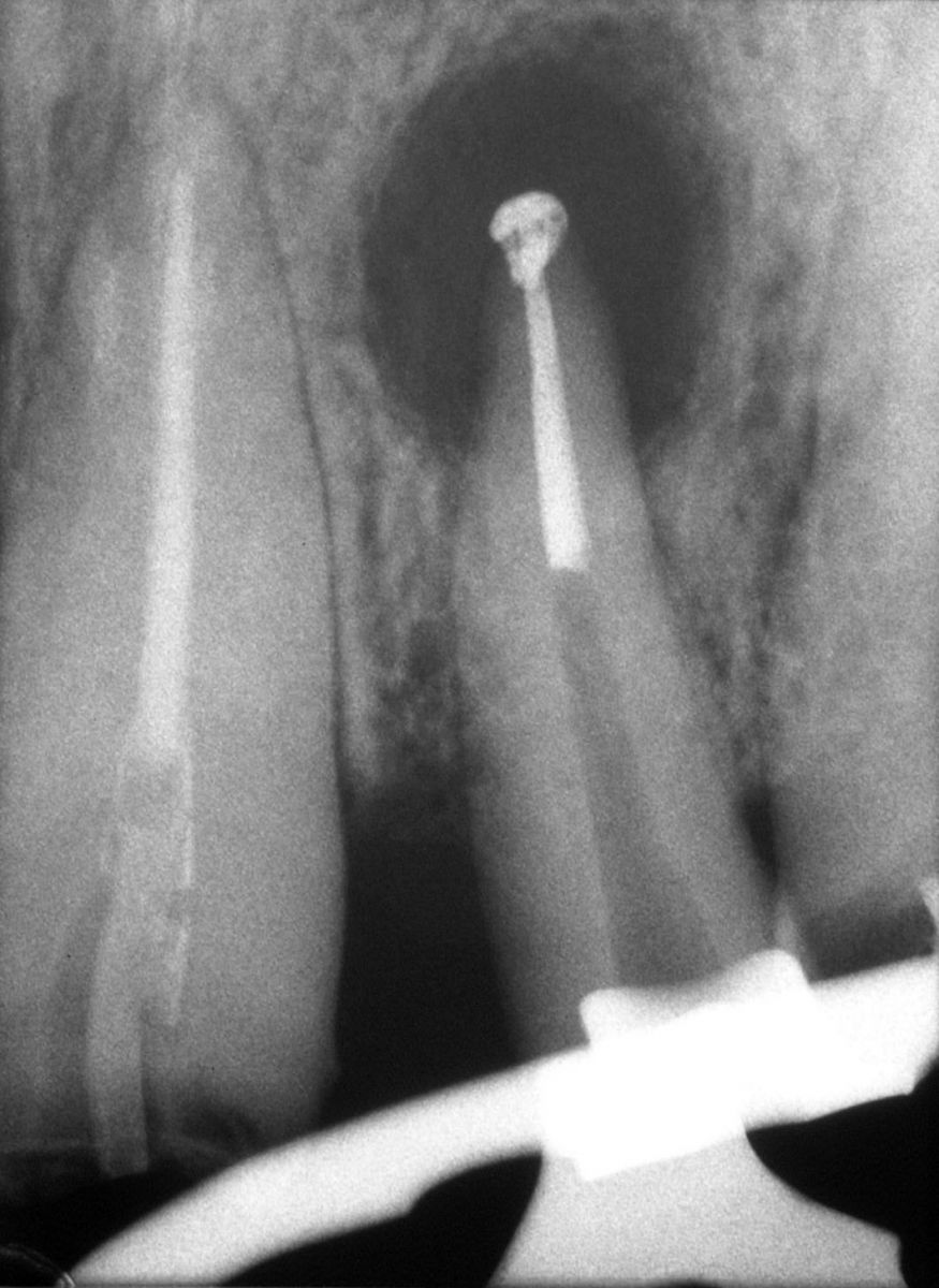 Endodonzia chirurgica