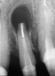 Endodonzia chirurgica