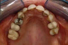 Corone in ceramica integrale