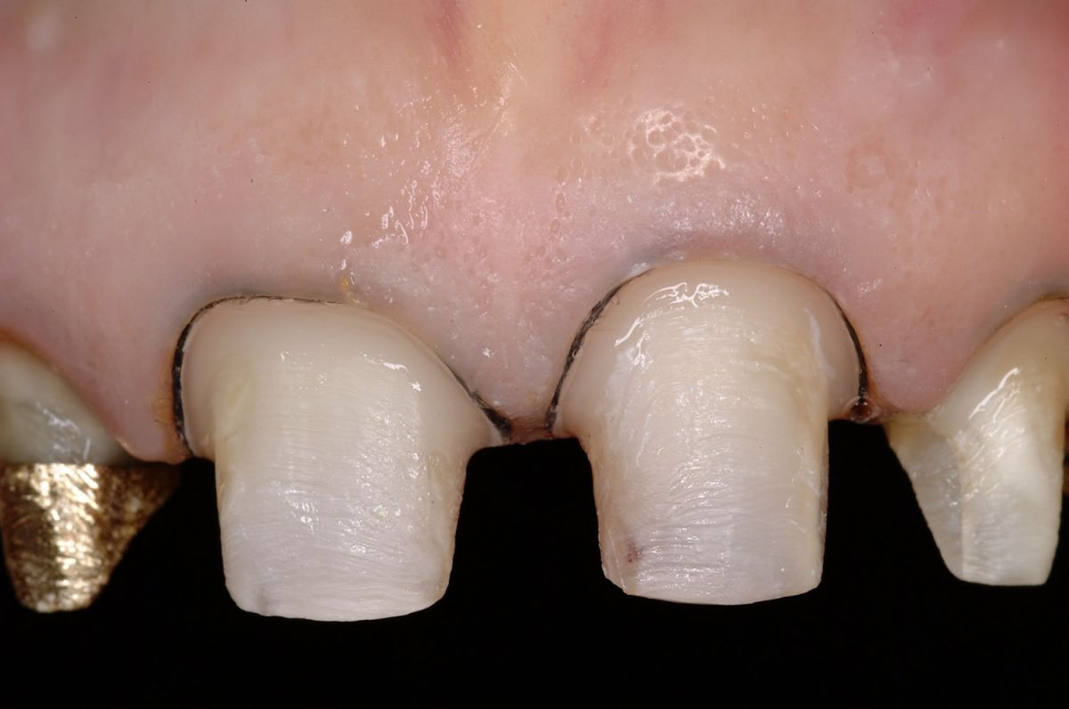 Corone in ceramica integrale