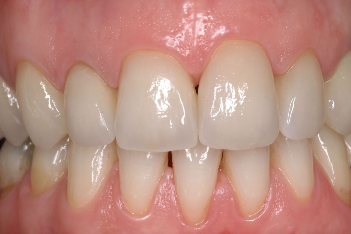 Corone in ceramica integrale