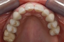 Corone in ceramica integrale
