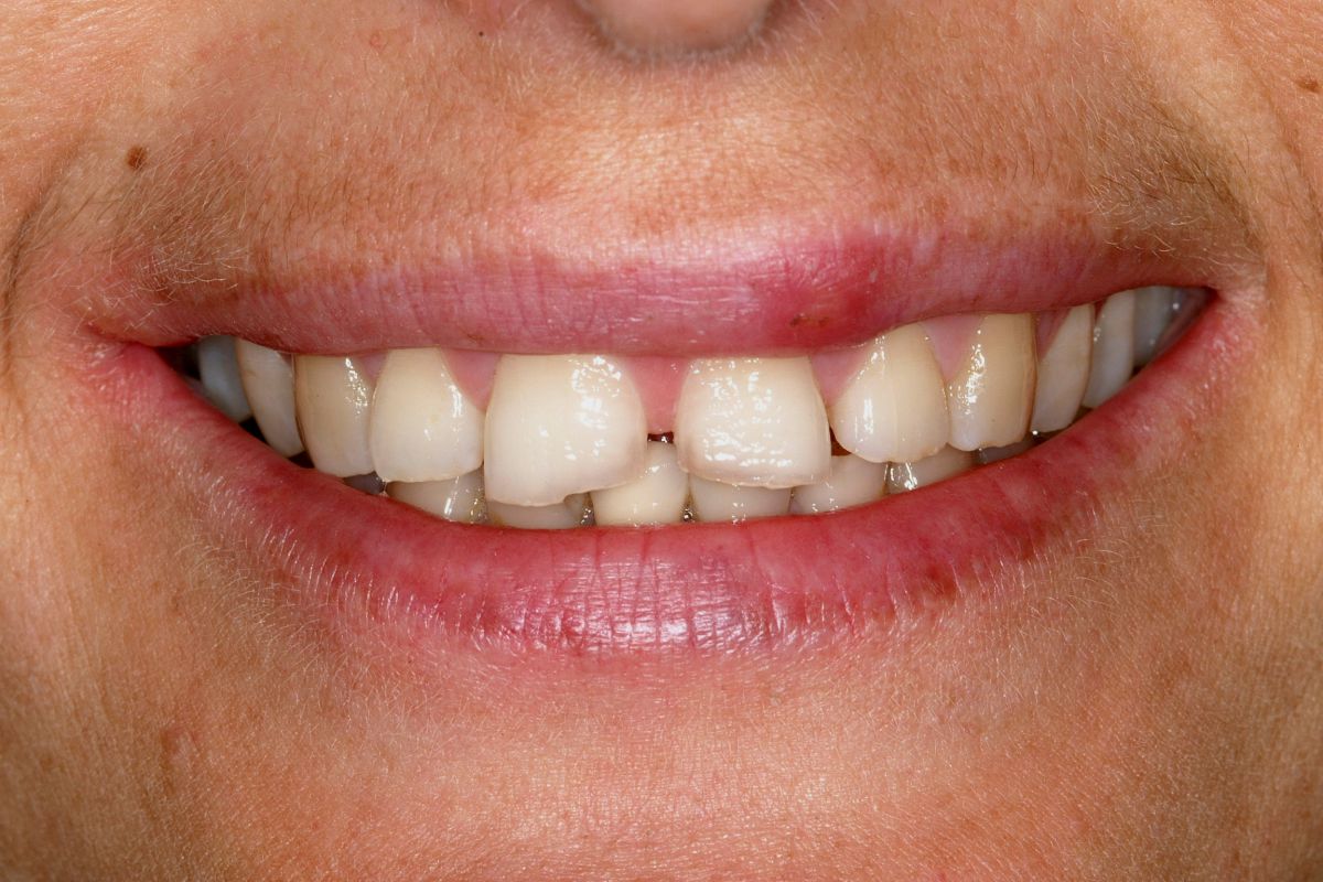 Corone in ceramica integrale