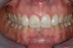 Corone in ceramica integrale