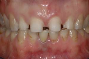 Corone in ceramica integrale