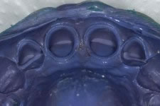 Faccette in ceramica