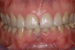 Corone in ceramica integrale
