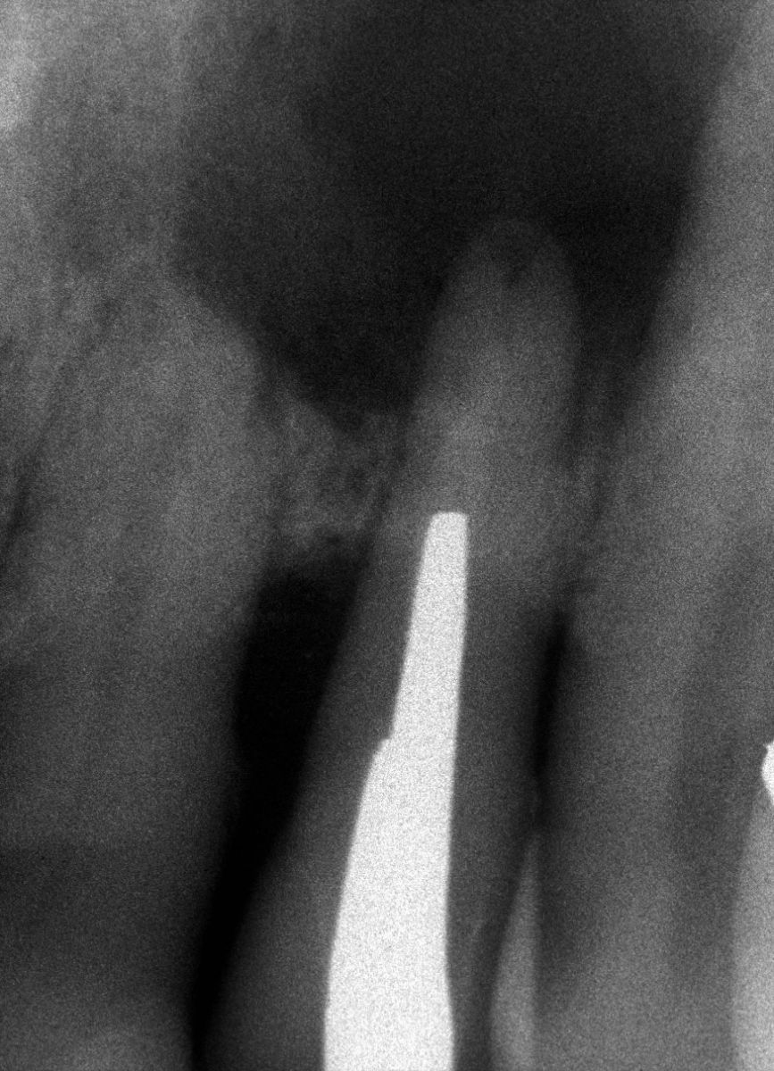 Endodonzia chirurgica