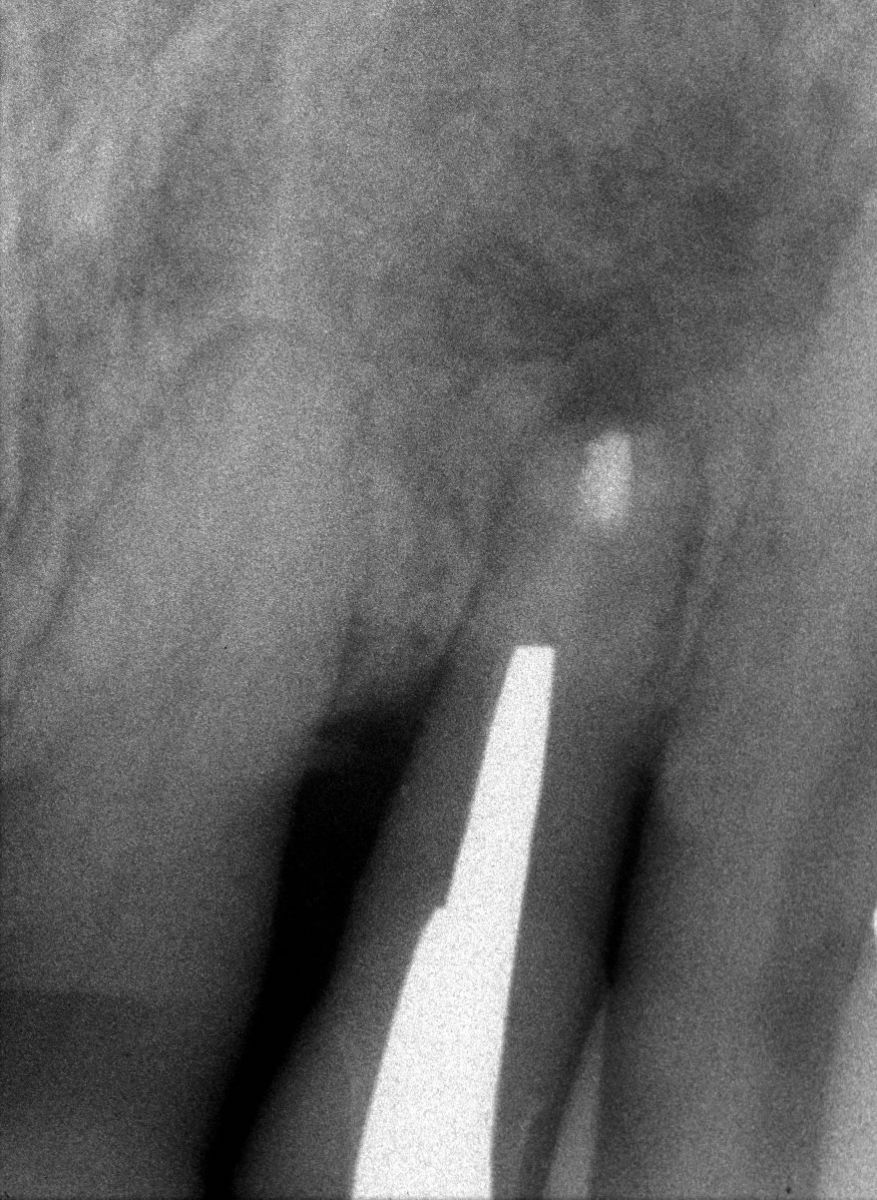Endodonzia chirurgica