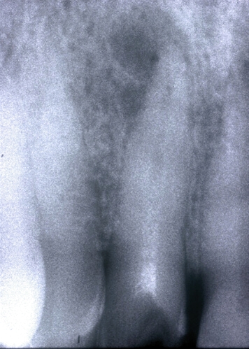 Ritrattamenti endodontici