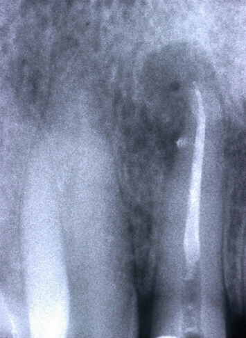 Ritrattamenti endodontici