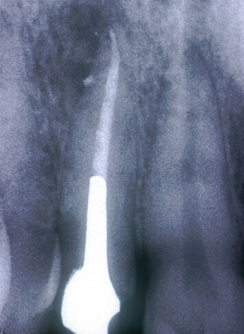 Ritrattamenti endodontici