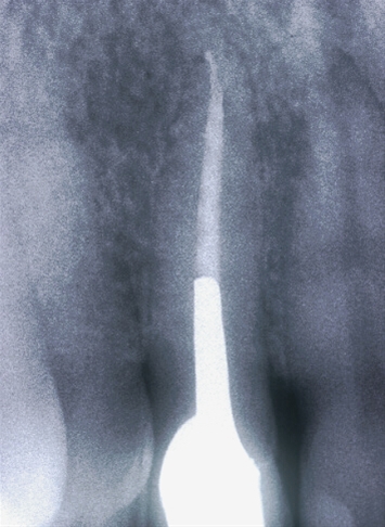 Ritrattamenti endodontici