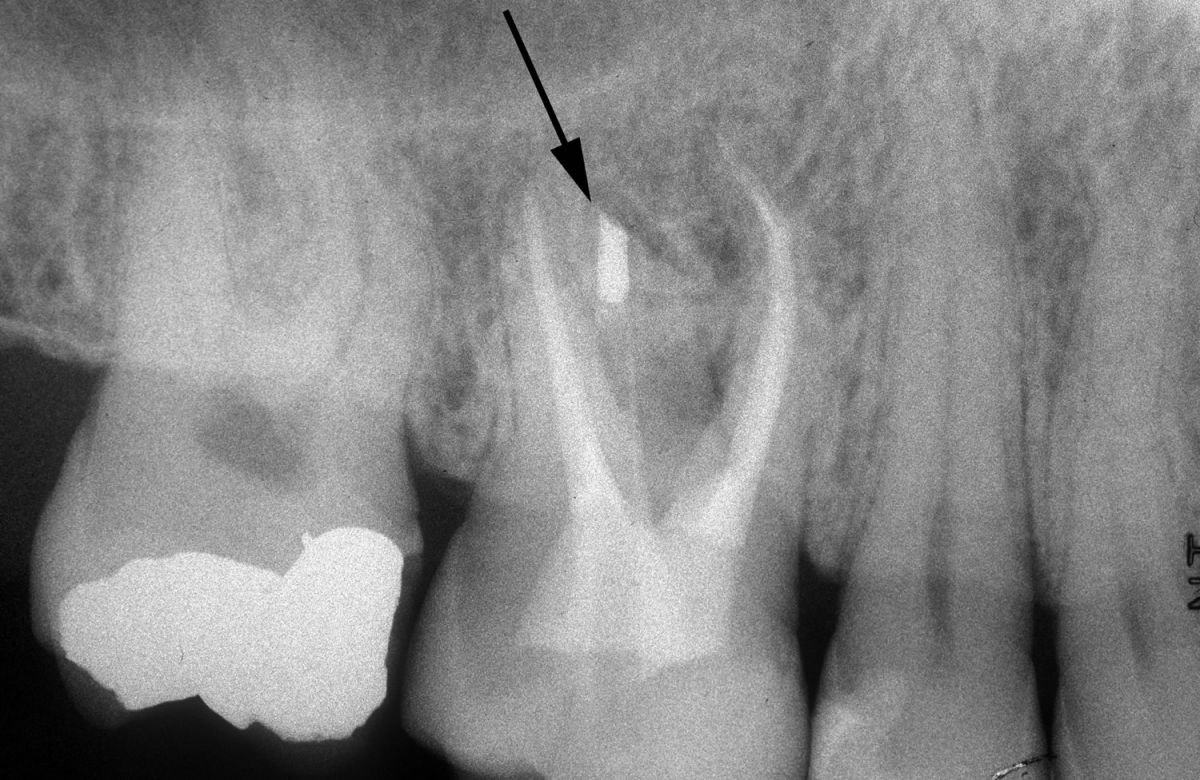 Endodonzia chirurgica
