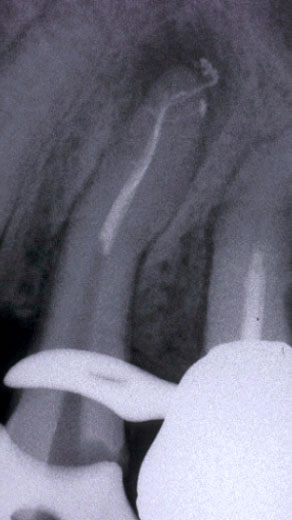 Endodonzia chirurgica