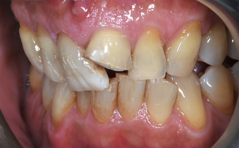 Malposizioni dentali e affollamenti