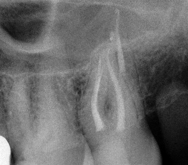 Trattamenti endodontici