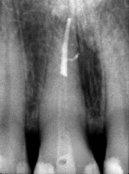 Trattamenti endodontici