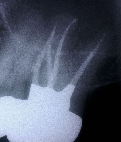 Trattamenti endodontici