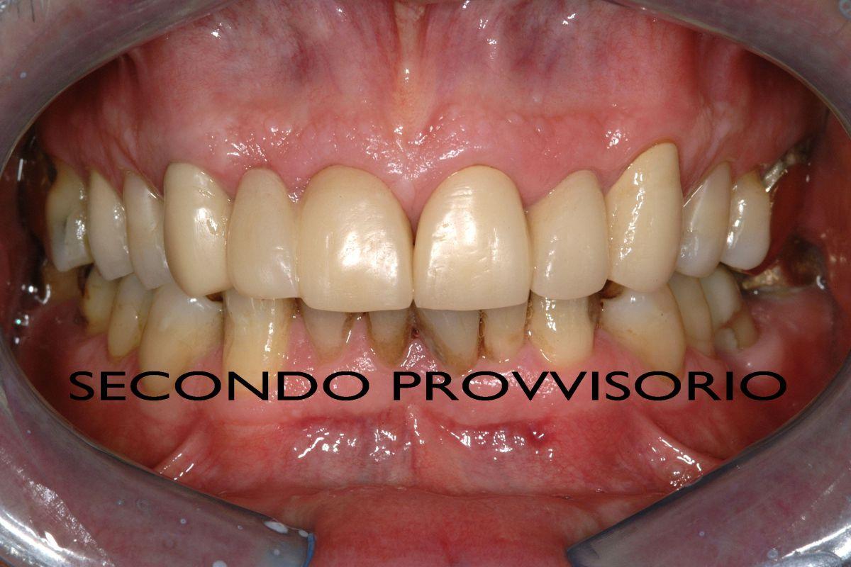 Provvisorio