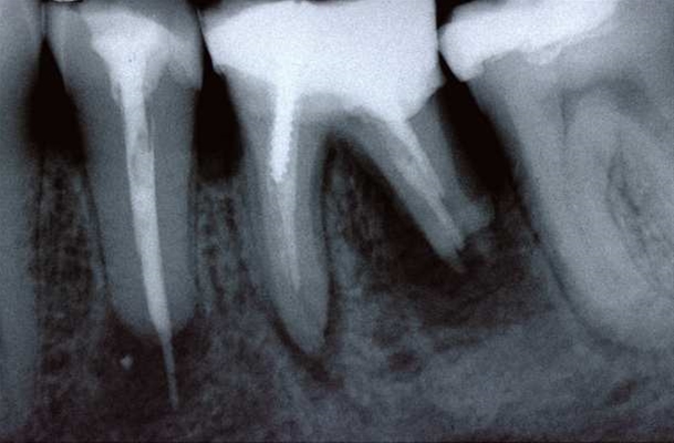 Riassorbimenti