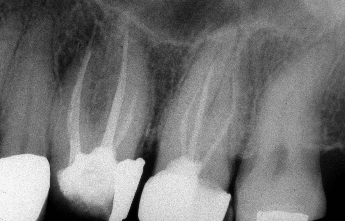 Endodonzia chirurgica