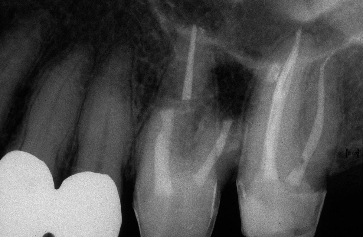 Endodonzia chirurgica