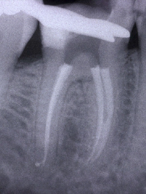 Trattamenti endodontici