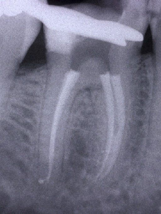 Trattamenti endodontici