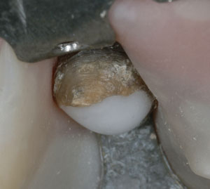 Sbiancamento dei denti devitalizzati