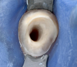 Sbiancamento dei denti devitalizzati