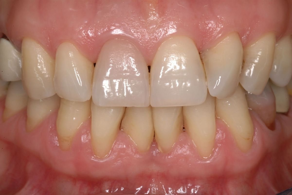 Sbiancamento dei denti devitalizzati