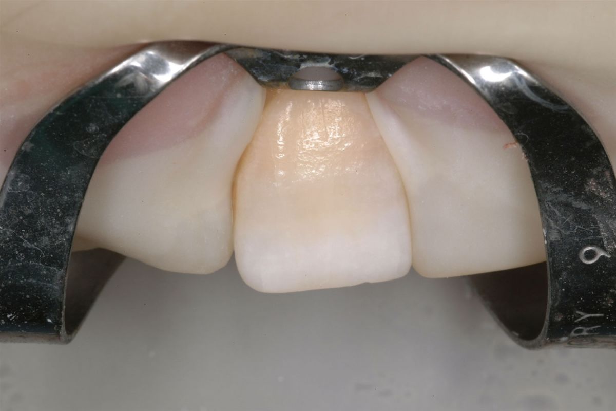 Sbiancamento dei denti devitalizzati