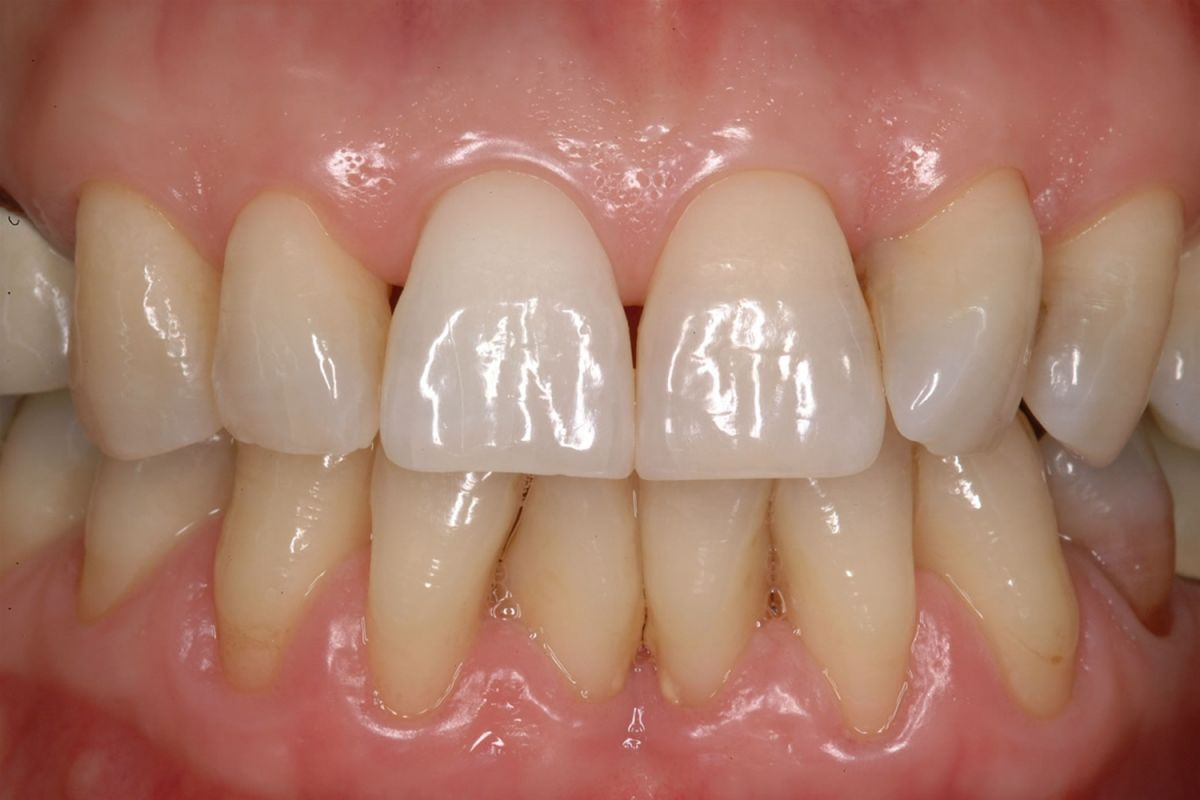 Sbiancamento dei denti devitalizzati
