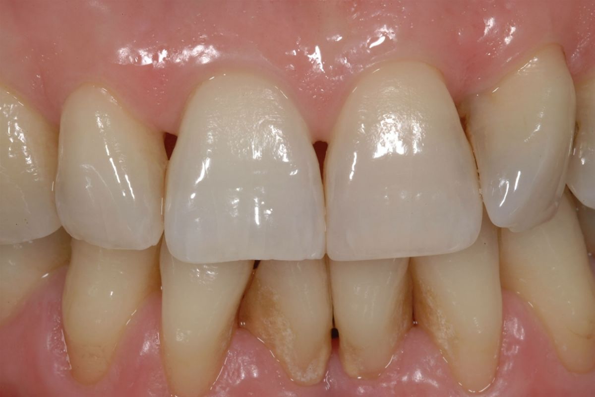 Sbiancamento dei denti devitalizzati