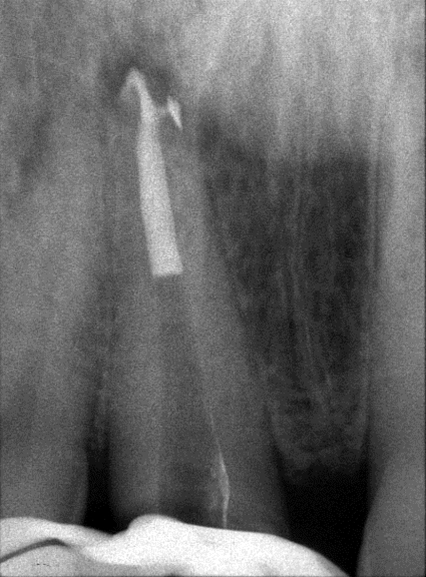 Trattamenti endodontici