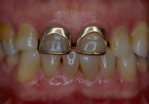 Corone in ceramica integrale