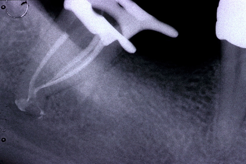 Trattamenti endodontici