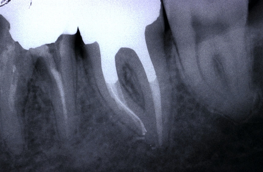 Ritrattamenti endodontici